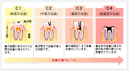 虫歯の進行レベル