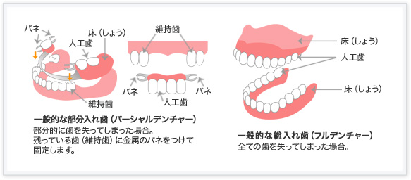 入れ歯