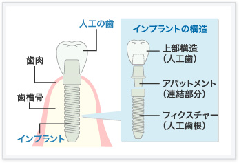 インプラントのしくみ